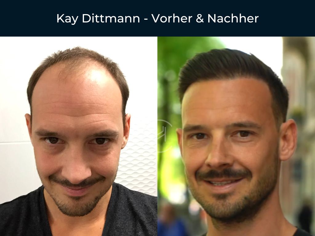 Kay Dittmann - Vorher & Nachher Haartransplantation
