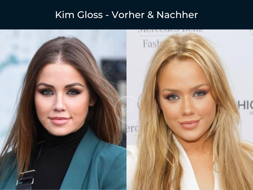 Kim Gloss - Vorher & Nachher Haartransplantation