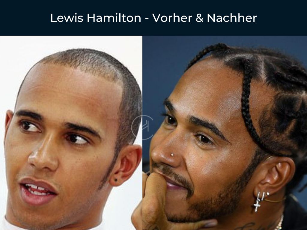 Lewis Hamilton - Vorher & Nachher Haartransplantation Lewis Hamilton - Vorher & Nachher Haartransplantation