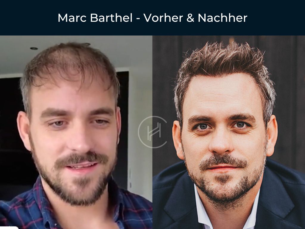 Marc Barthel - Vorher & Nachher Haartransplantation Marc Barthel - Vorher & Nachher Haartransplantation