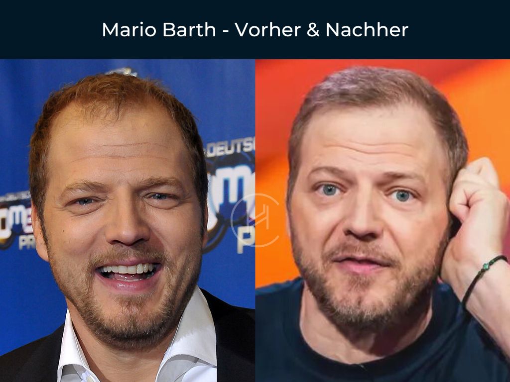 Mario Barth - Vorher & Nachher Haartransplantation