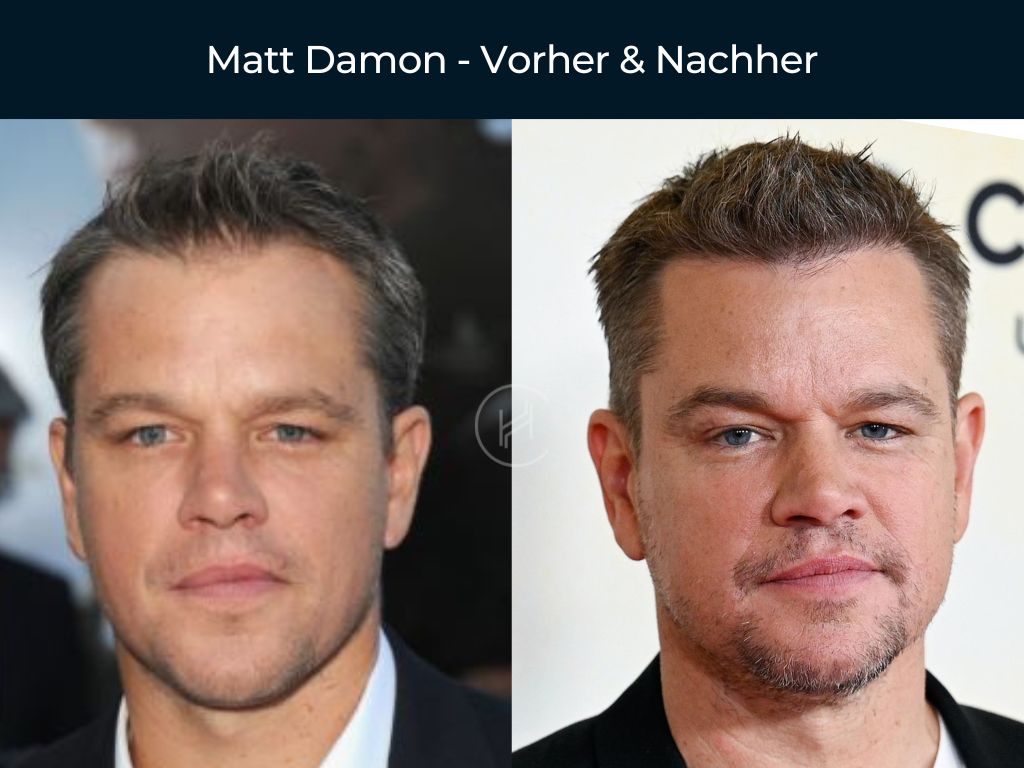 Matt Damon - Vorher & Nachher Haartransplantation Matt Damon - Vorher & Nachher Haartransplantation