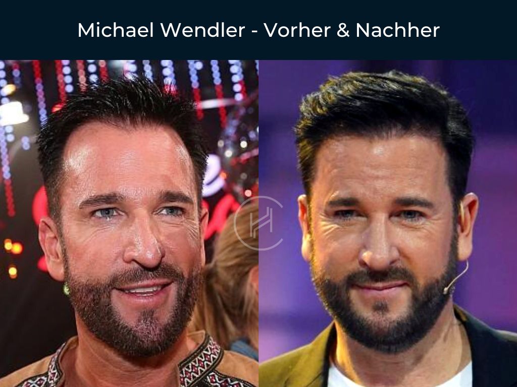 Michael Wendler - Vorher & Nachher Haartransplantation
