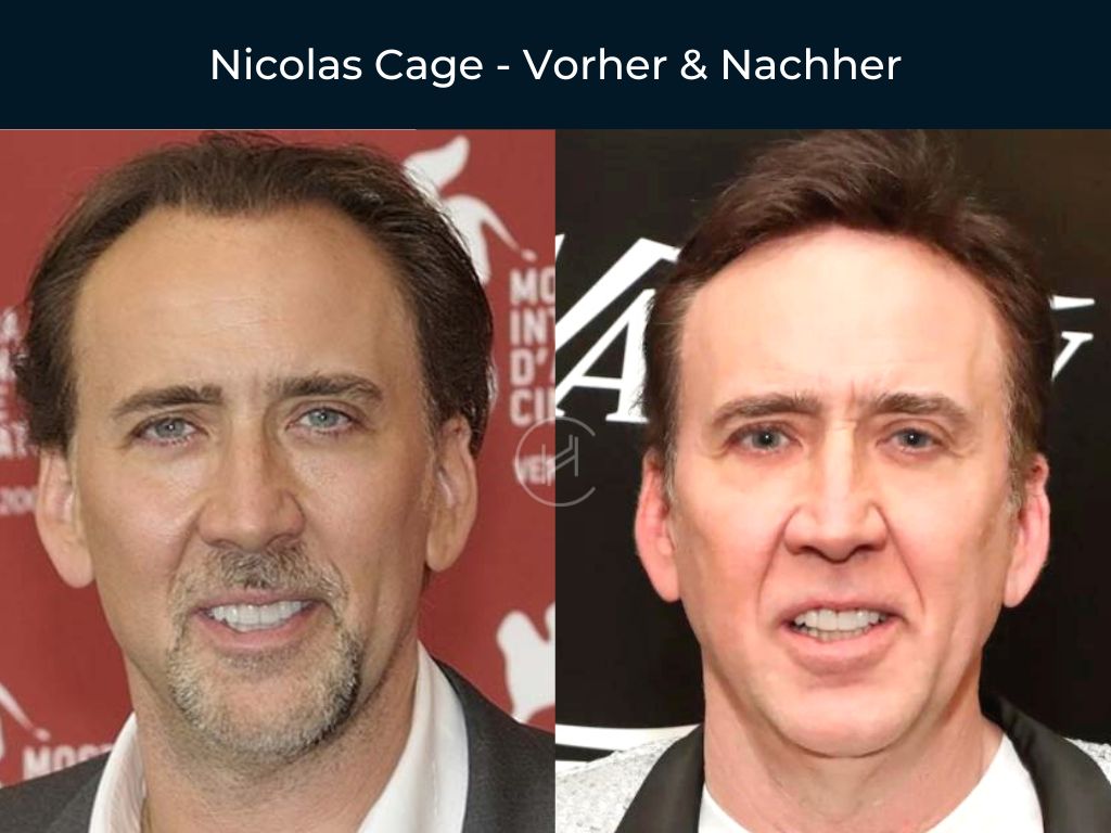 Nicolas Cage - Vorher & Nachher Haartransplantation