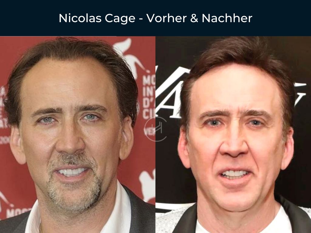 Nicolas Cage - Vorher & Nachher Haartransplantation Nicolas Cage - Vorher & Nachher Haartransplantation