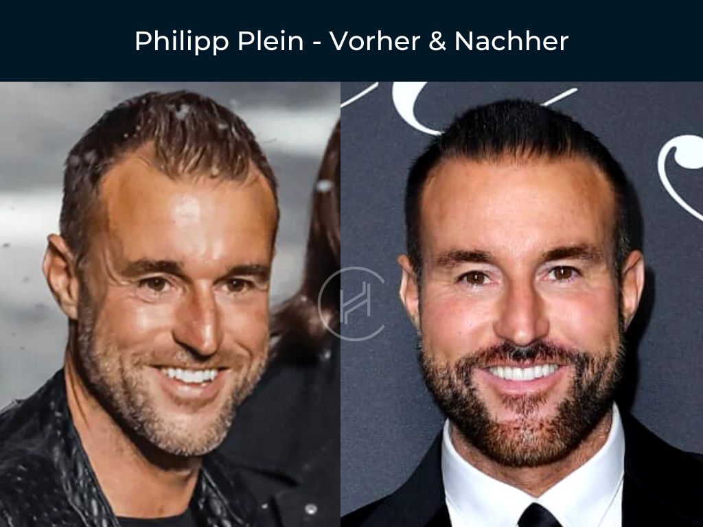 Philipp Plein - Vorher & Nachher Haartransplantation