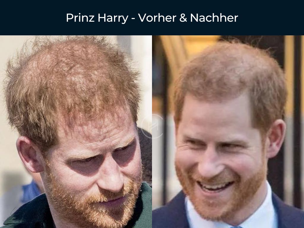 Prinz Harry - Vorher & Nachher Haartransplantation