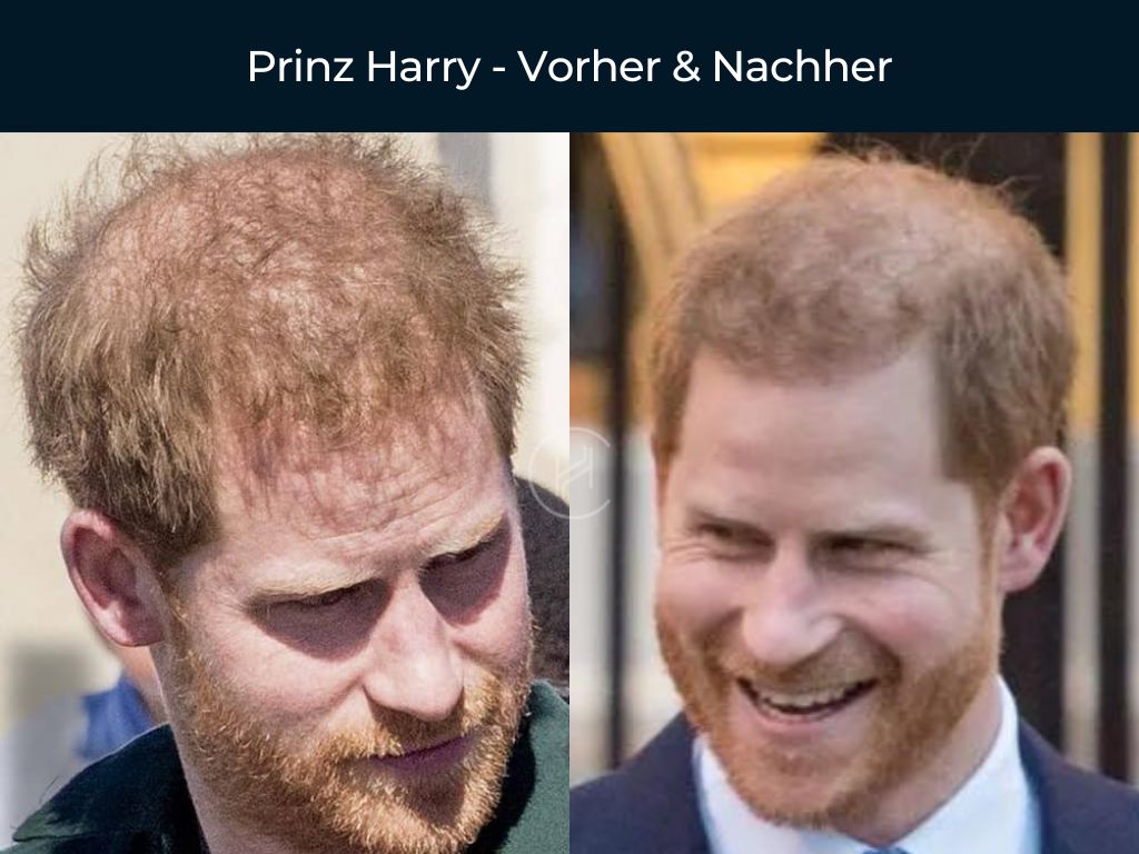 Prinz Harry - Vorher & Nachher Haartransplantation Prinz Harry - Vorher & Nachher Haartransplantation