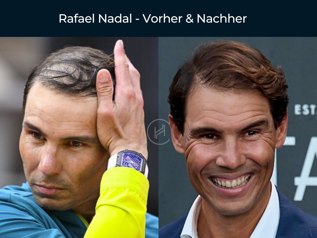 Rafael Nadal - Vorher & Nachher Haartransplantation Rafael Nadal - Vorher & Nachher Haartransplantation