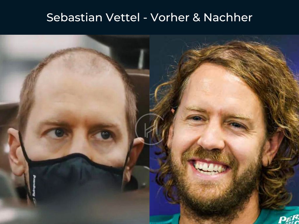 Sebastian Vettel - Vorher & Nachher Haartransplantation