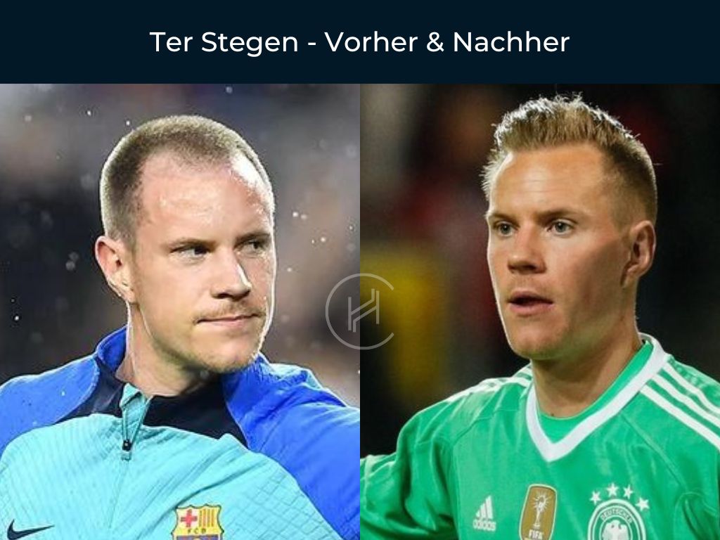 Ter Stegen - Vorher & Nachher Haartransplantation Ter Stegen - Vorher & Nachher Haartransplantation