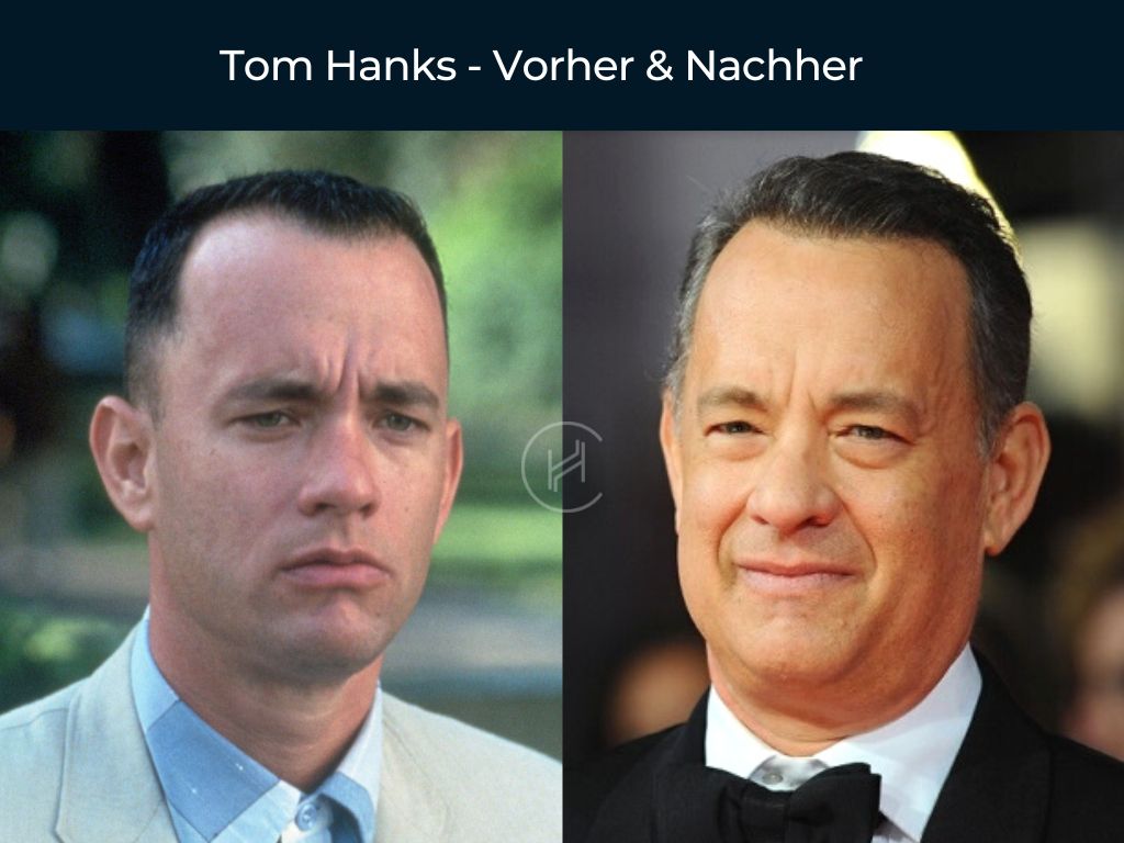 Tom Hanks - Vorher & Nachher Haartransplantation