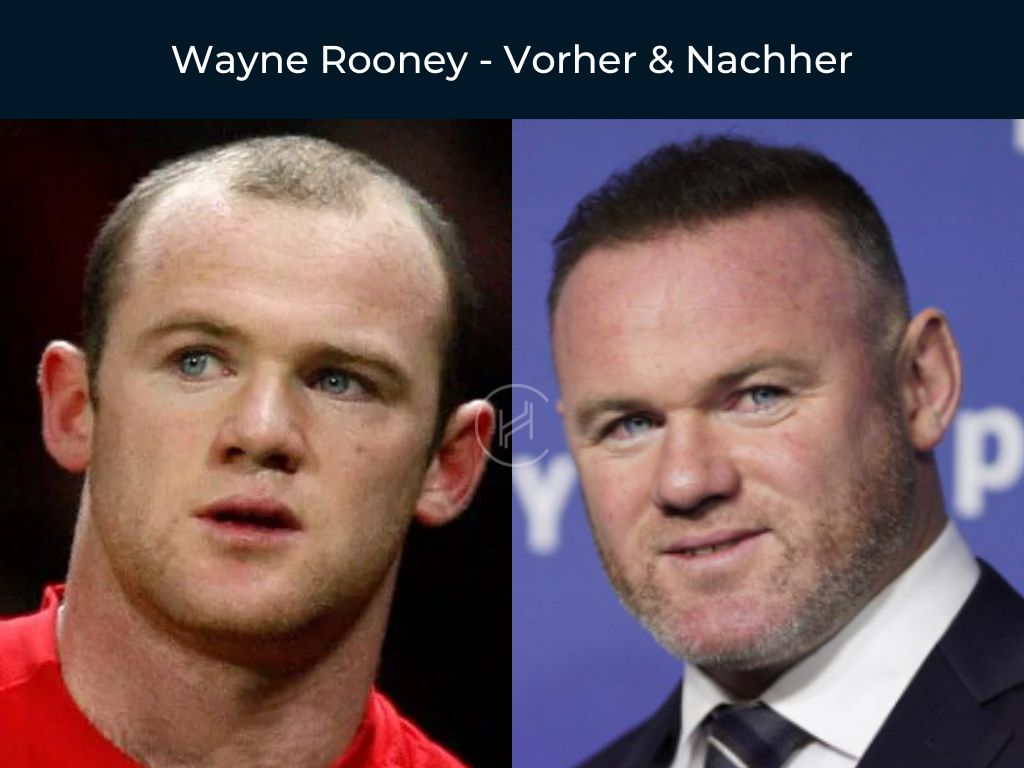 Wayne Rooney - Vorher & Nachher Haartransplantation