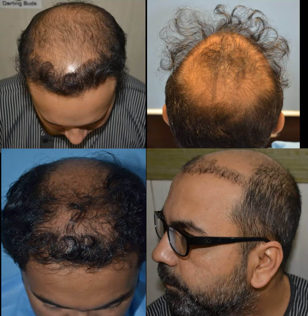 Beispiel einer fehlgeschlagenen Haartransplantation - Warum scheitern Haartransplantationen