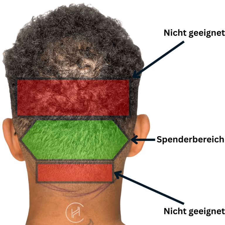 Der Spenderbereich bei Haartransplantationen Der Spenderbereich bei Haartransplantationen