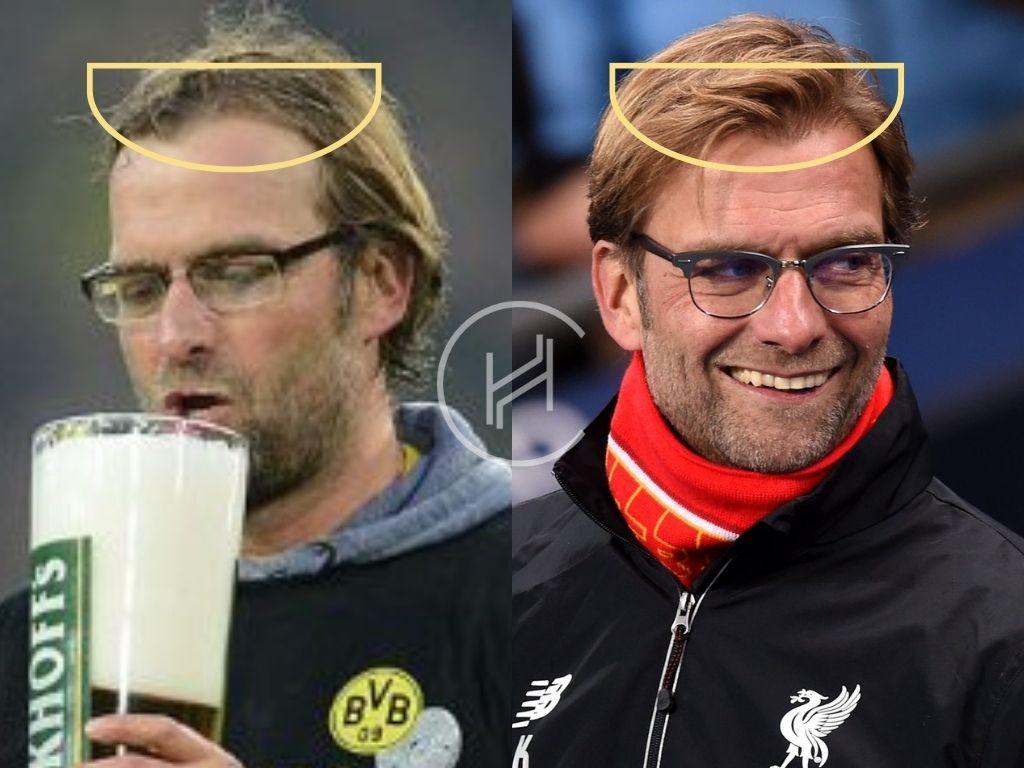 Haartransplantation Vorher Nachher - Jürgen Klopp