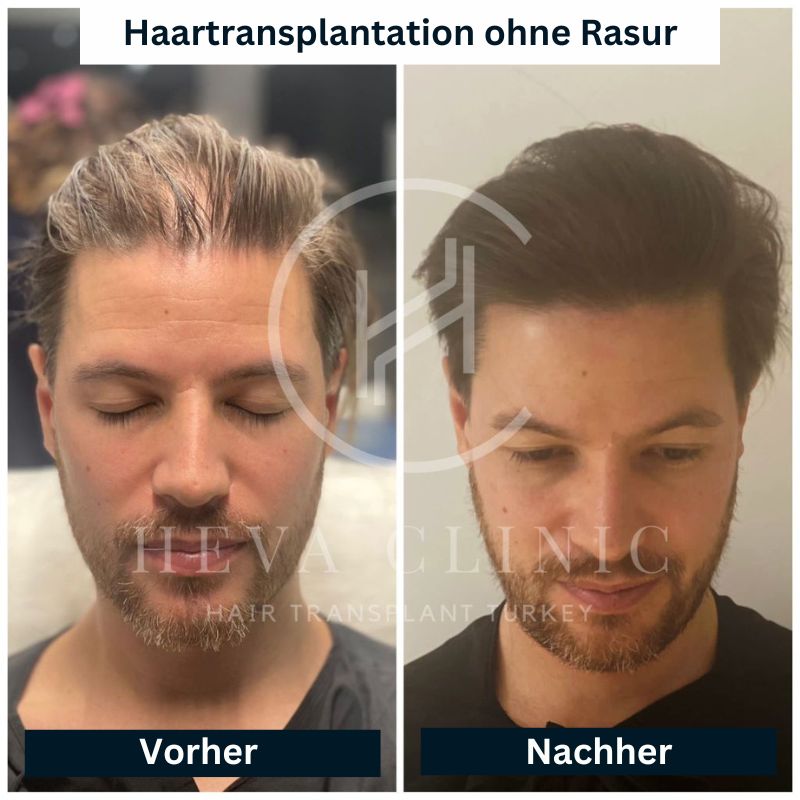 Haartransplantation ohne Rasur Vorher Nachher