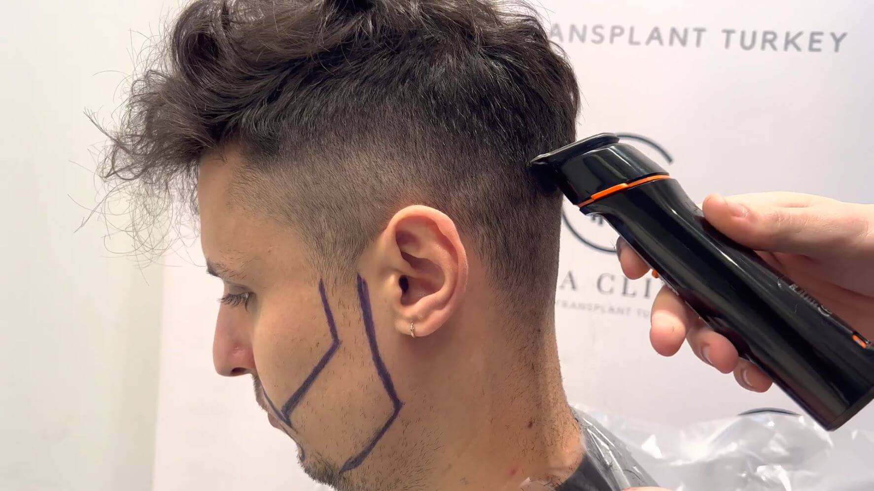 Haartransplantationen-Spenderbereich Haartransplantationen-Spenderbereich
