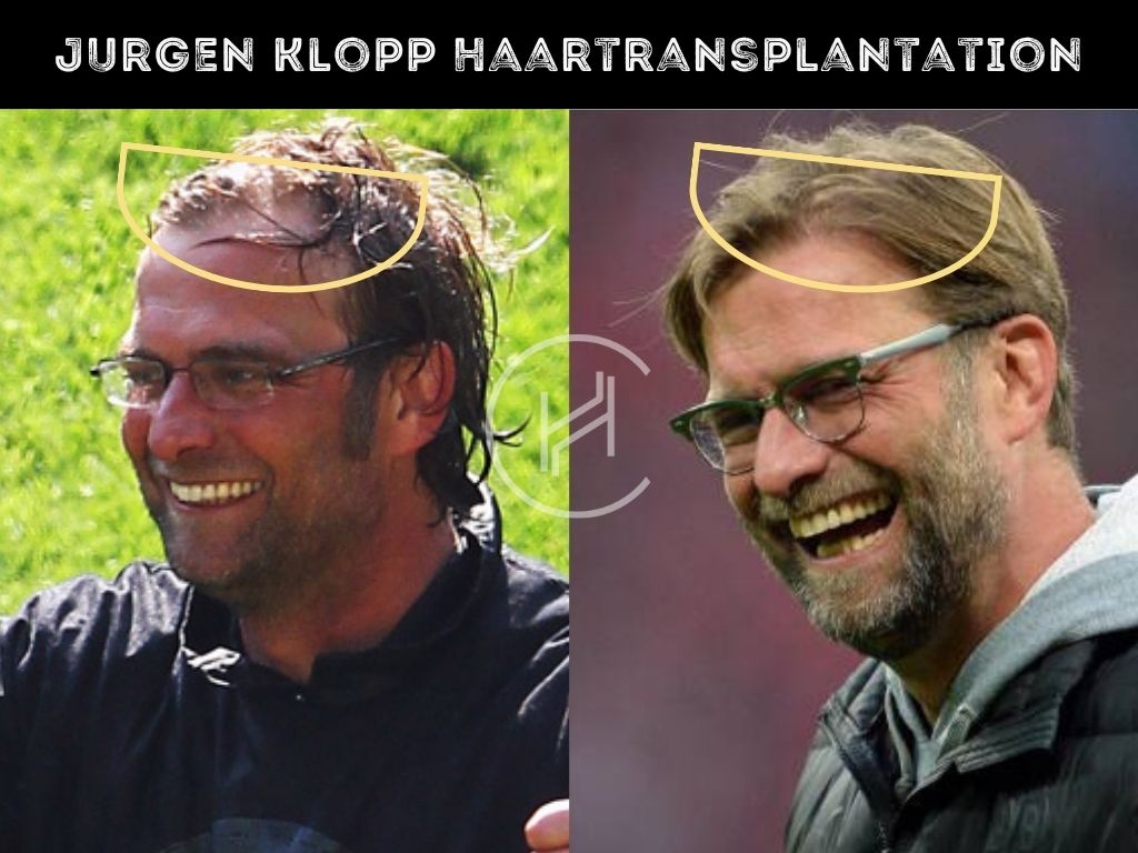 Jurgen Klopp Haartransplantation Vorher und Nachher