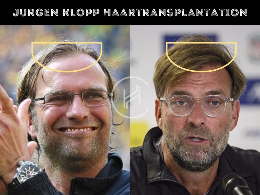 Jürgen Klopp vor und nach der Haartransplantation