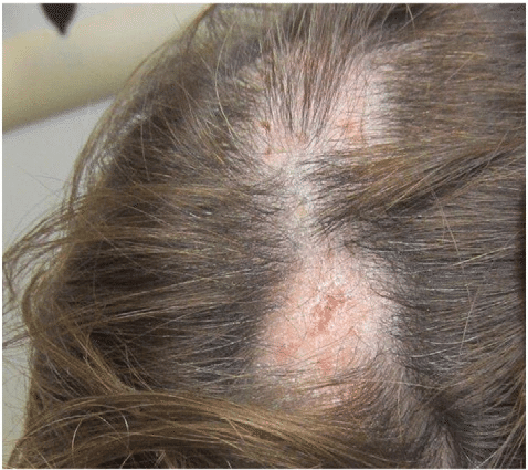 Lichen planopilaris (LLP) Krankheit auf der Kopfhaut