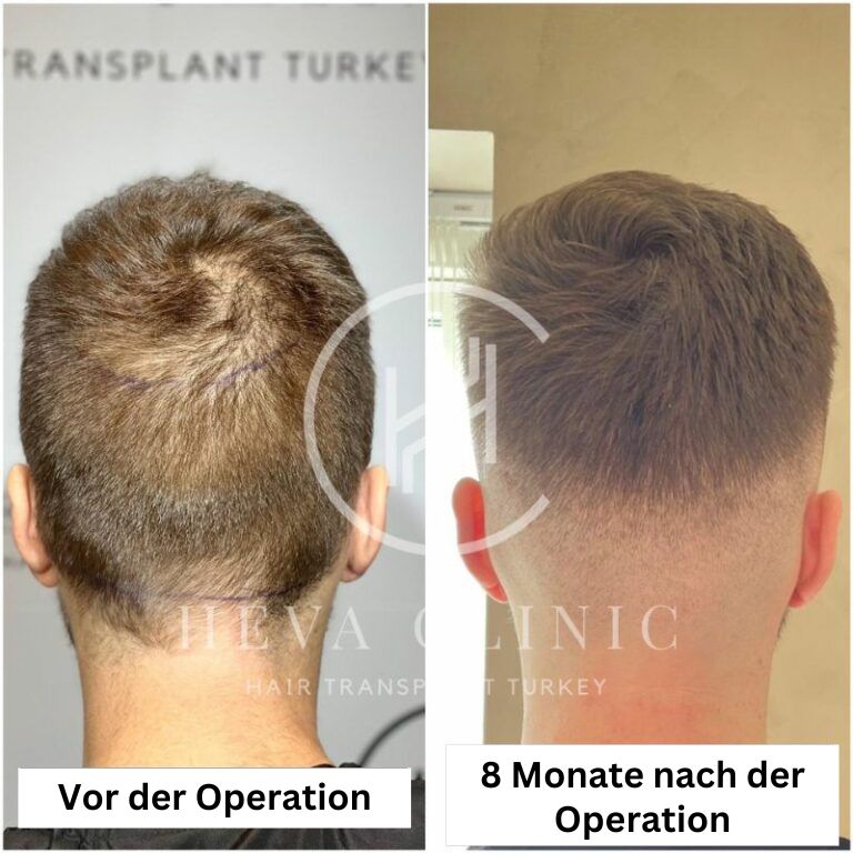 Spenderbereich 8 monate nach der haartransplantation