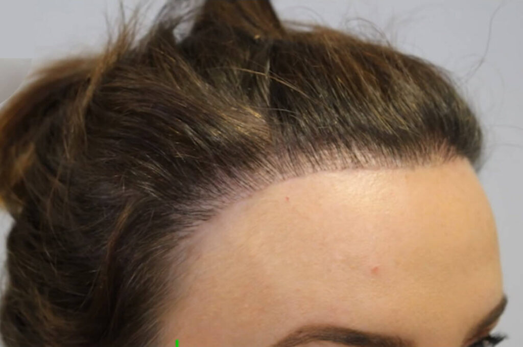 Unnatürliche Haartransplantationgeringe transplantierte Haardichte Unnatürliche Haartransplantationgeringe transplantierte Haardichte