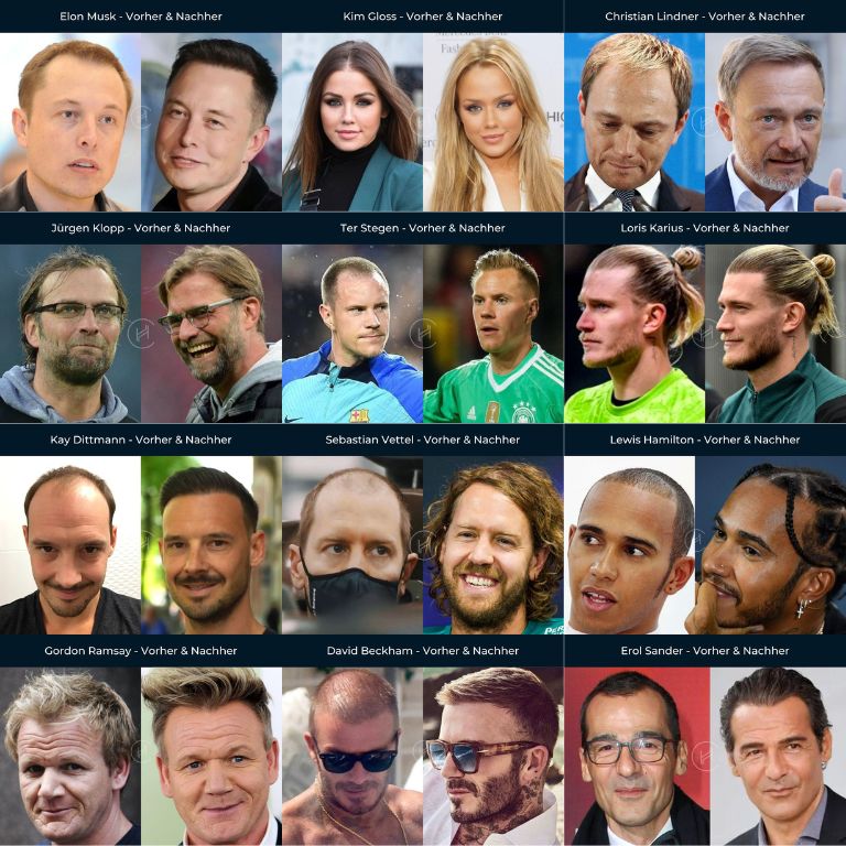 mit-haartransplantation-vorher-nachher-promis mit-haartransplantation-vorher-nachher-promis