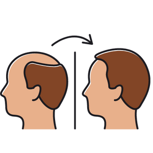 Symbol für das Endergebnis der Haartransplantation