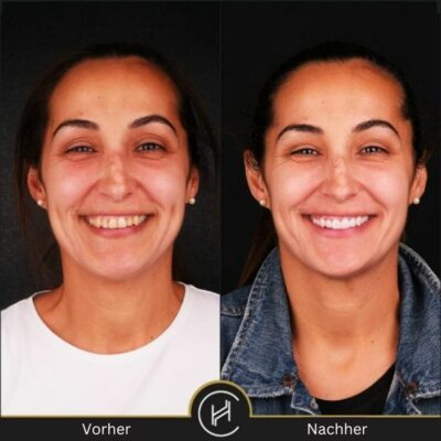 Veneers-in-der-Türkei-vorher-nachher