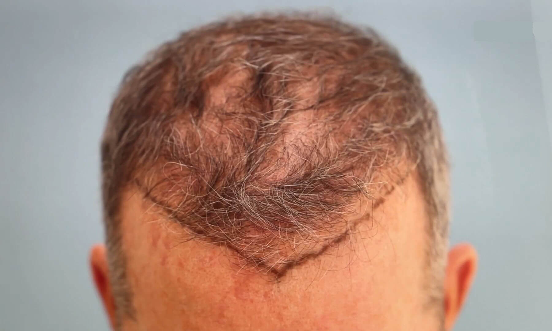 zweite Haartransplantation Kandidaten weite Haartransplantation Vorher