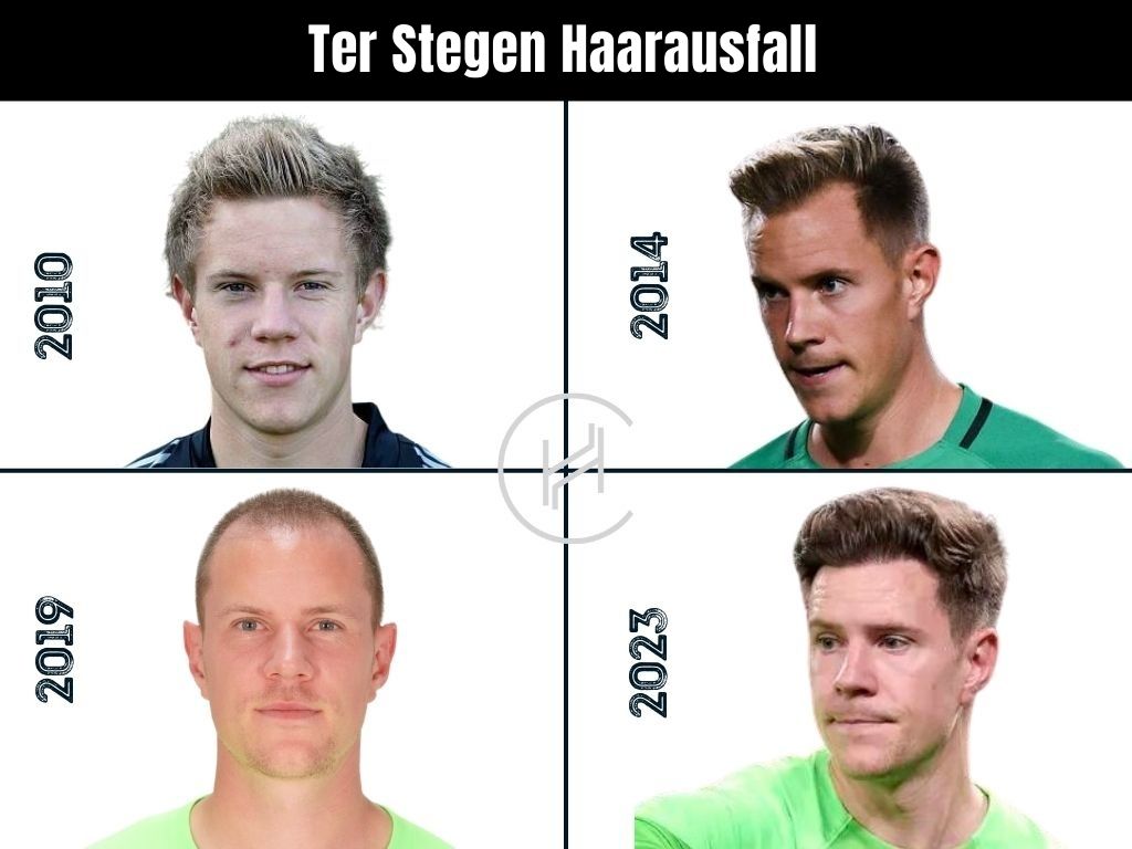 Ter Stegen Haarausfall