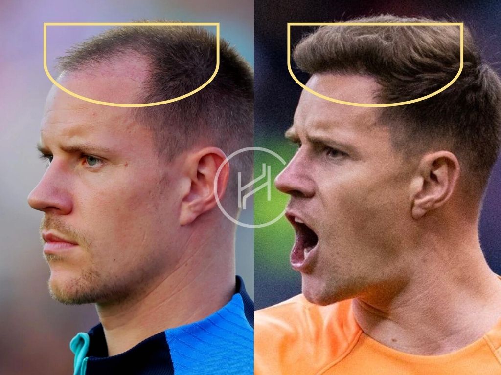 Ter Stegen Haartransplantation Vorher & Nachher Seitenwinkel