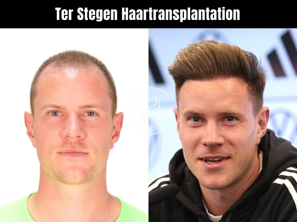 Ter Stegen Haartransplantation vorher und nachher