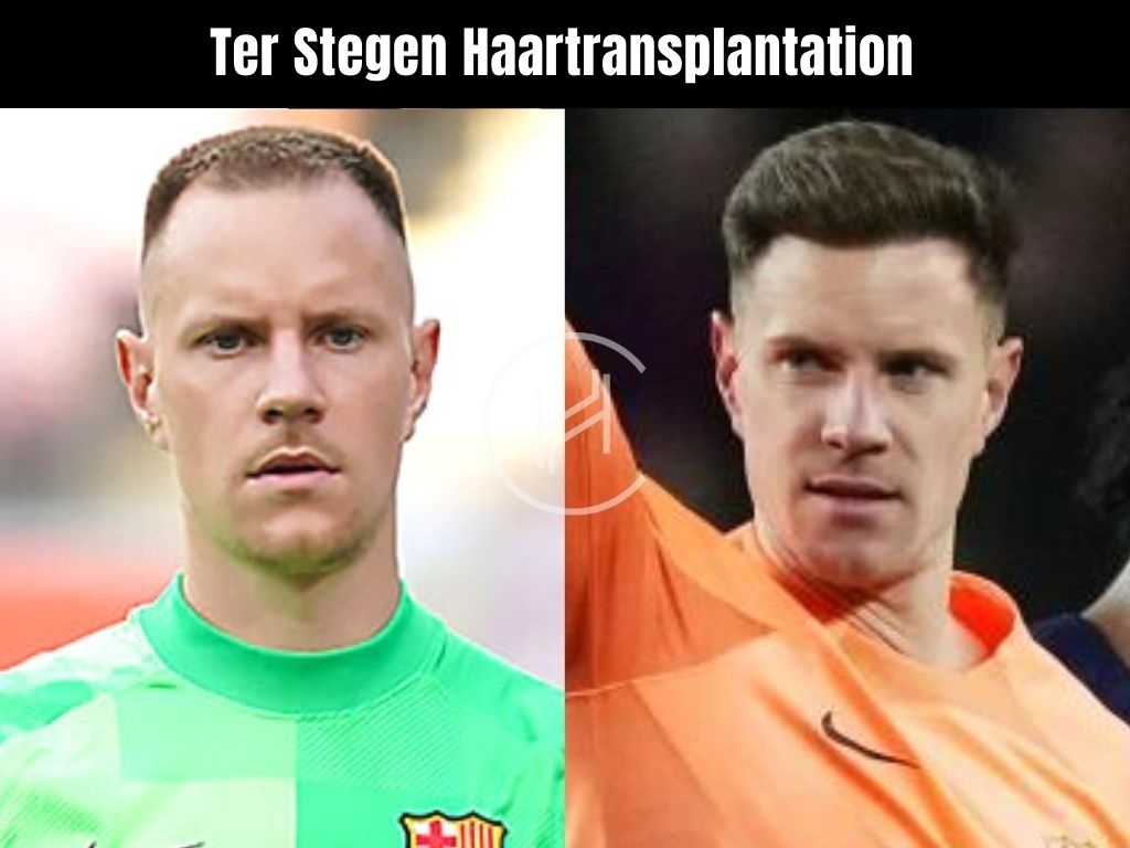 vorher-nachher-Ter-Stegen-Haartransplantation