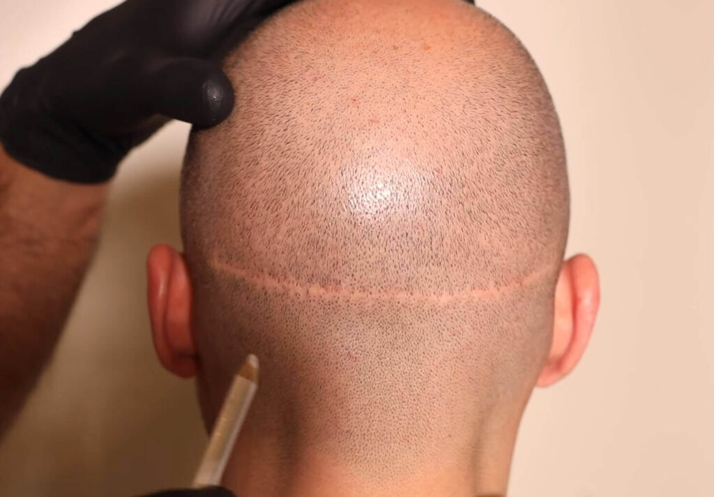 fut haartransplantation narbe