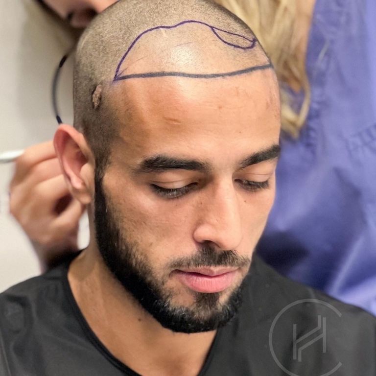 haartransplantation auf narbe