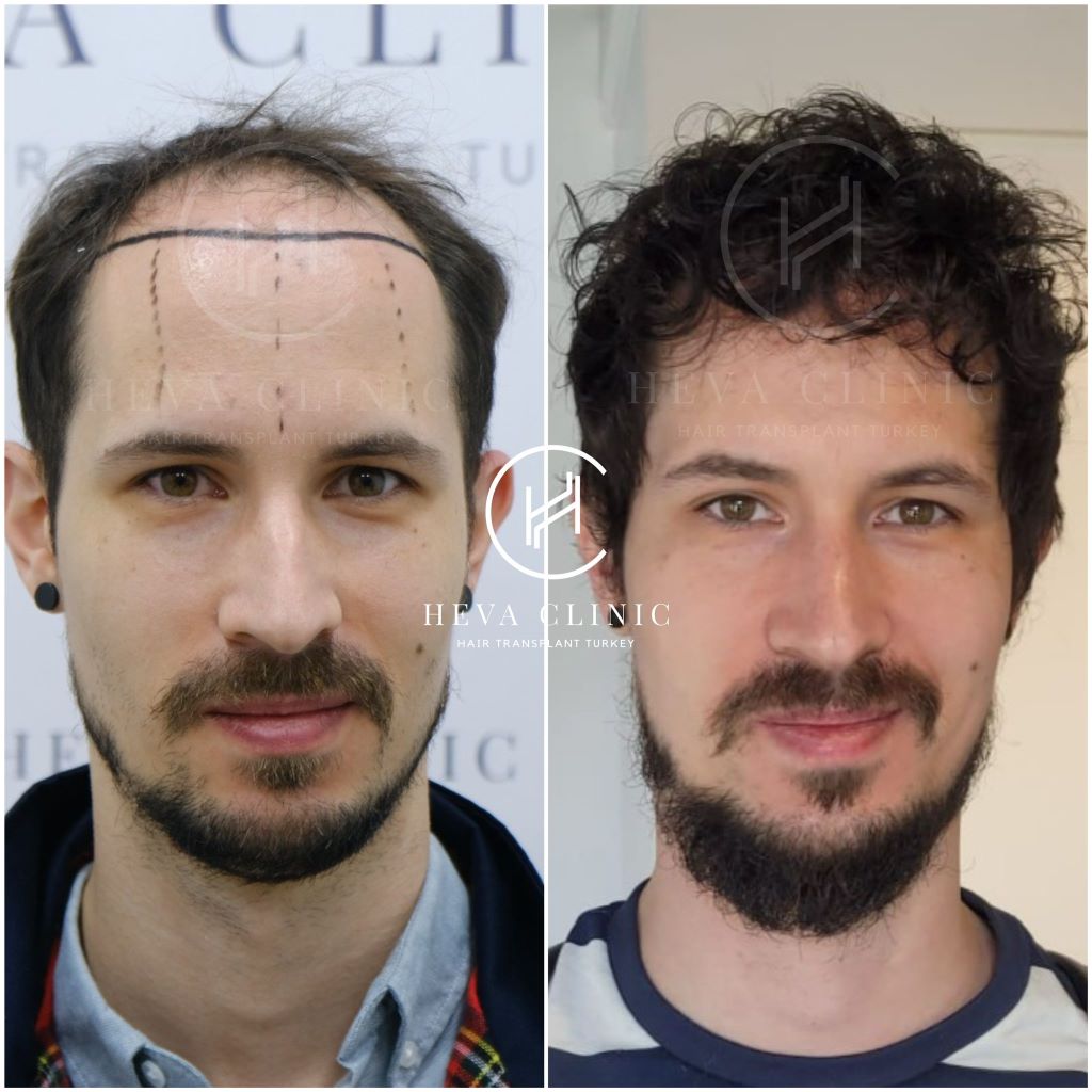 4000 Grafts Haartransplantation Vorher & Nachher Ergebnis von Heva Clinic