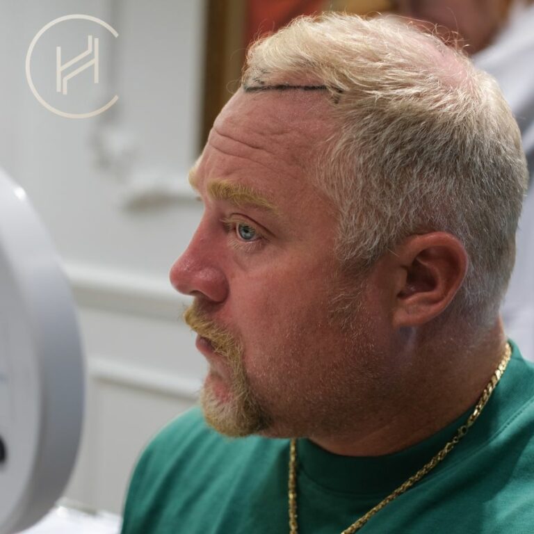 Fue Haartransplantation in der Türkei in der Heva Clinic Vorkonsultation