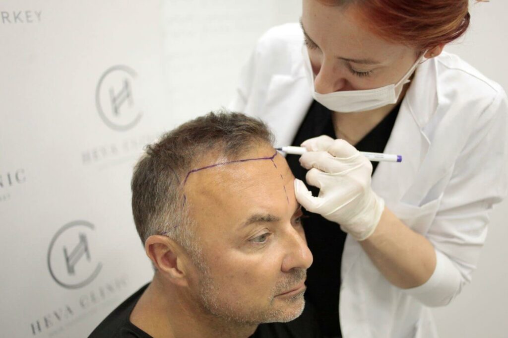 Haartransplantation Haaransatzplanung Mann im reifen Alter