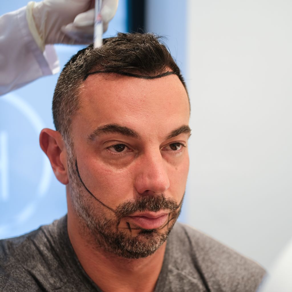 Haartransplantationskandidat vor der Operation