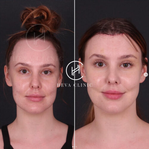 Vorher & Nachher Ergebnis der Stirnverkleinerungsoperation
