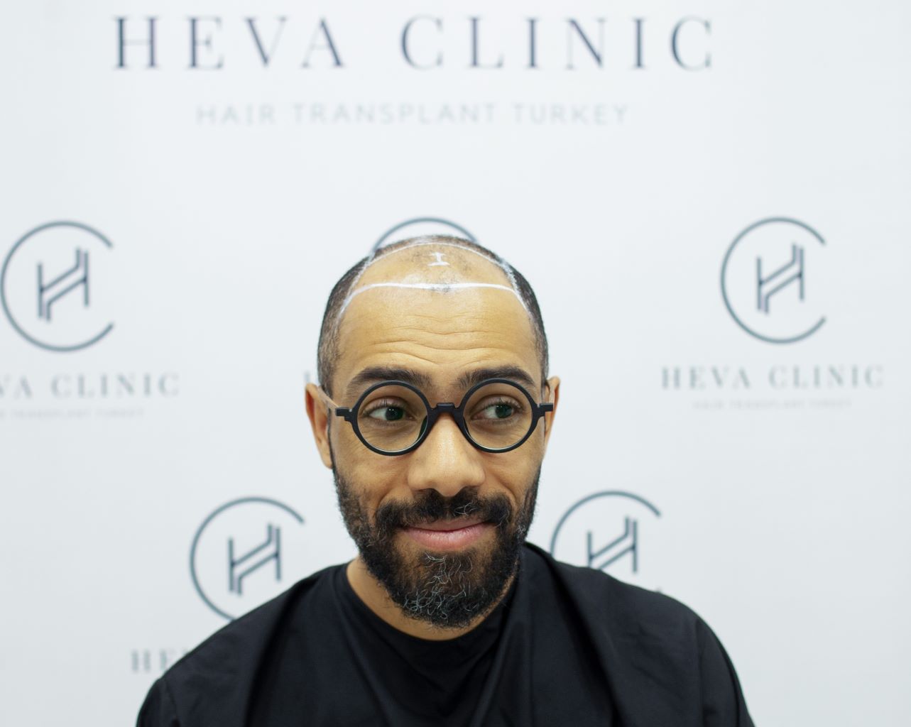 ideales Alter für eine Haartransplantation