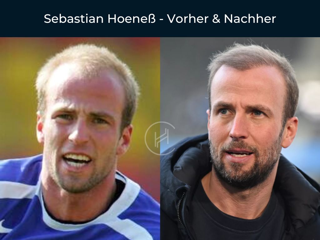 Sebastian Hoeneß Vorher Nachher Haartransplantation