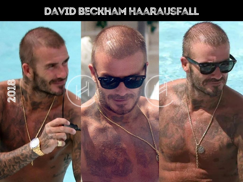 david beckham haarausfall