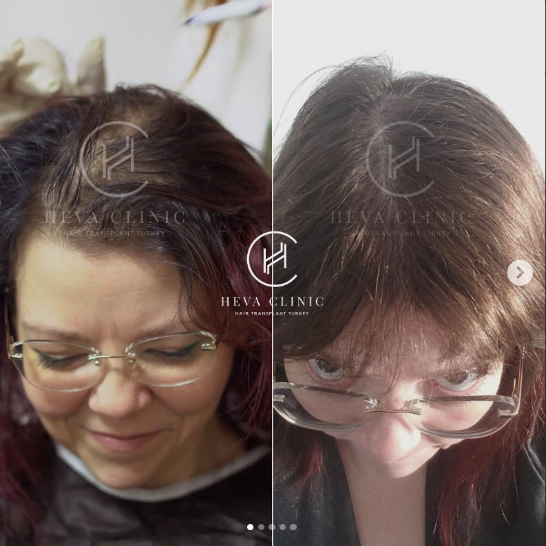 2500-grafts-unrasierte-weibliche-Haartransplantation-Vorher-Nachher-Ergebnis
