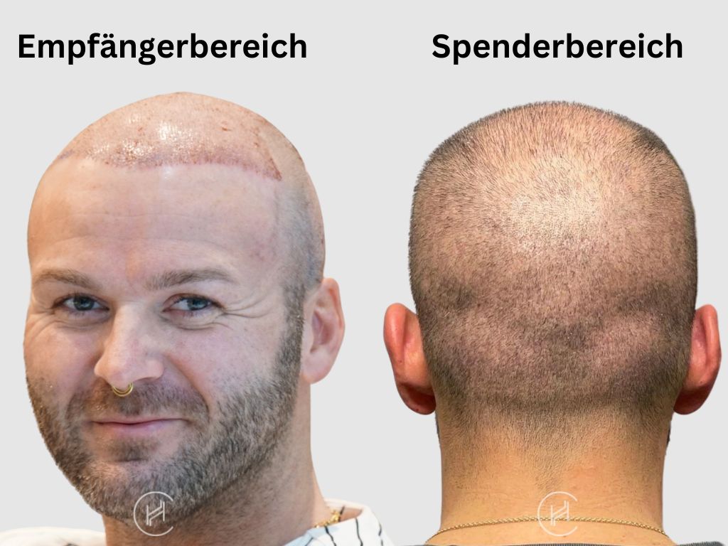 Empfängerbereich und Spenderbereich haartransplantation