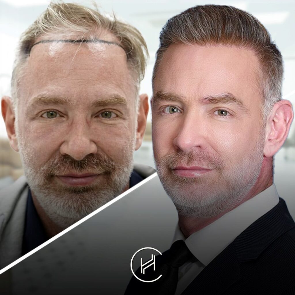 Erstaunliche Haartransplantation vor und nach Ergebnis Heva Clinic