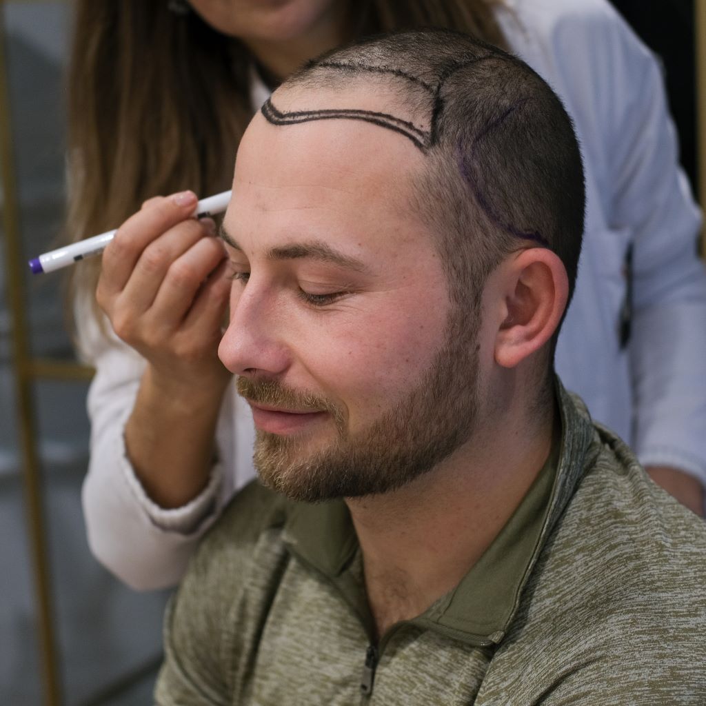 Haar transplantiert-männlich-patient-heva-clinic-turkei