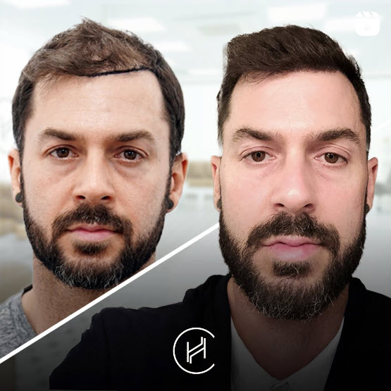 Haartransplantation vor und nach 1500 Grafts in Heva